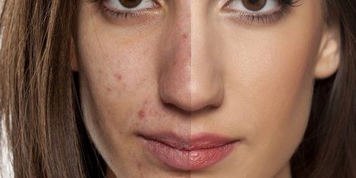 acne and low carb